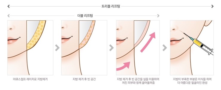 젊고 아름다운 얼굴을 위한 JW정원성형외과만의 노하우! 트리플리프팅 관련 이미지 2