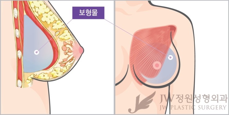 JW정원성형외과 가슴성형 √HD내시경 √하베스트젯2 √콤비네이션 가슴확대 관련 이미지 1