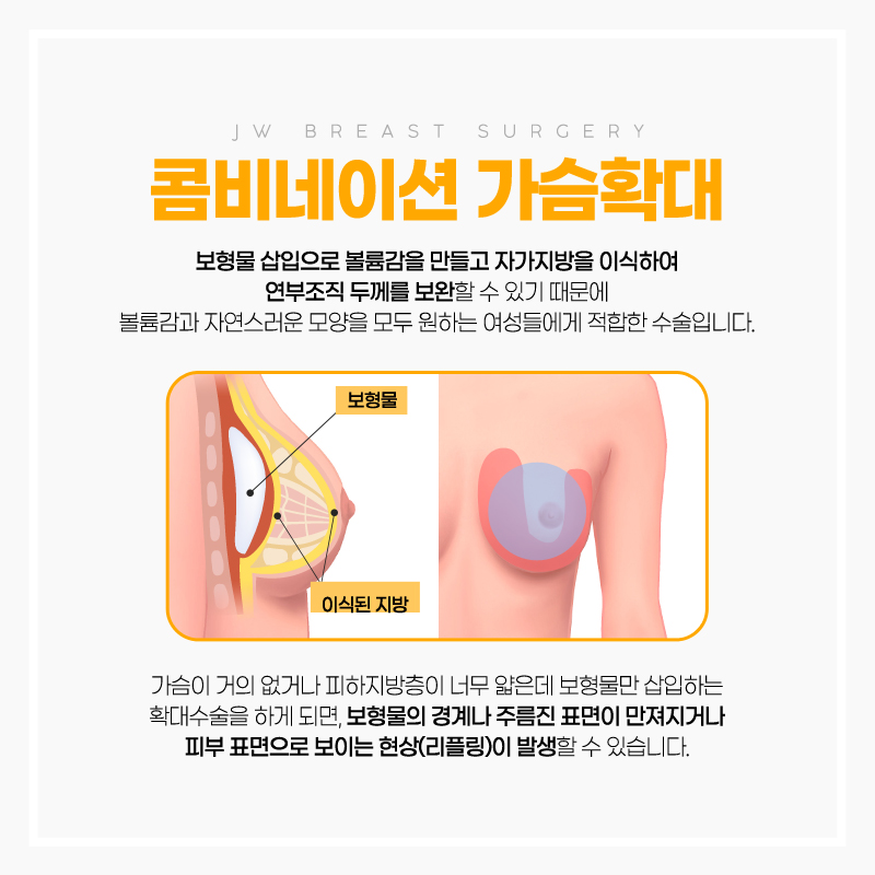 강남가슴수술 지방이식과 보형물 삽입을 동시에! 관련 이미지 2
