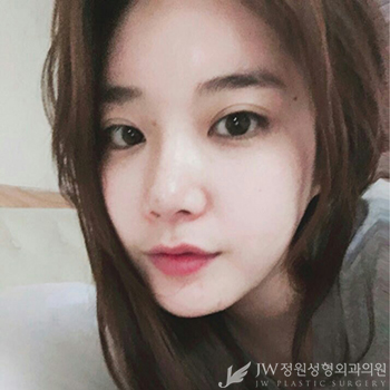 [JW정원성형외과] 안면윤곽 코성형 리얼 후기!!! 관련 이미지 8