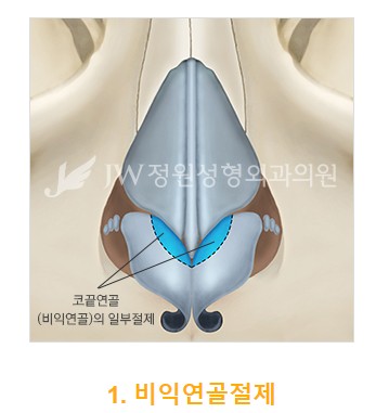 The Main Cause of a Long Nose in Aging! Making a Youthful Look with a Hooked Nose and Long Nose Surgery image 4