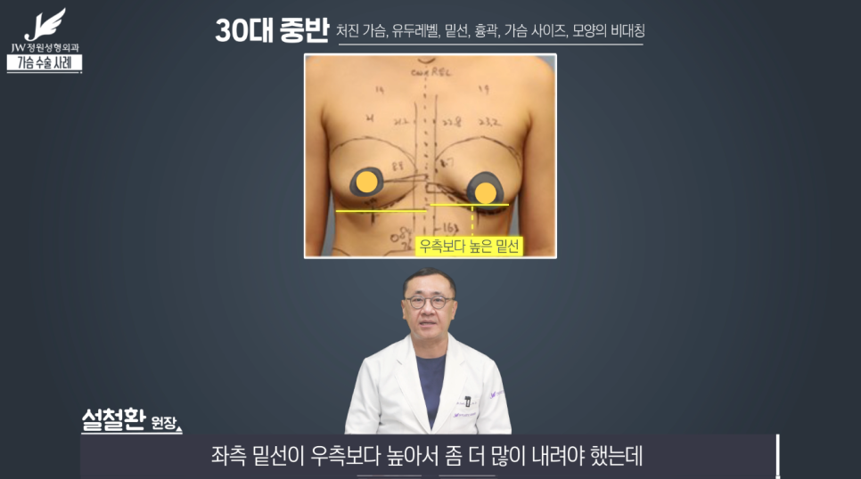 처진가슴교정 치밀한 계획으로 완성도는 UP! 【강남 JW정원성형외과】 관련 이미지 7
