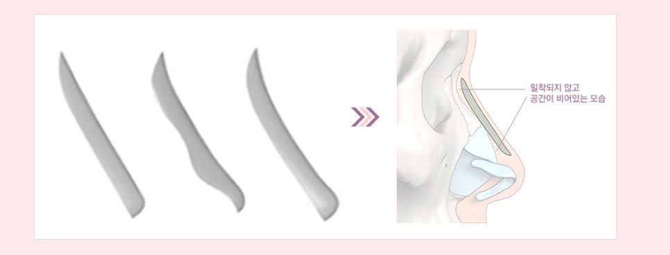 나에게 딱맞는 코수술, 3D맞춤보형물로 자연스럽게 관련 이미지 5