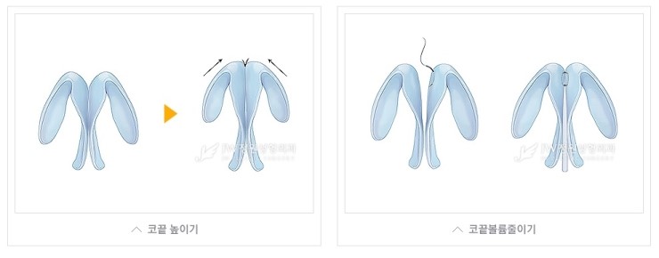 코끝에서 완성되는 아름다움! JW정원성형외과 코끝성형 관련 이미지 4