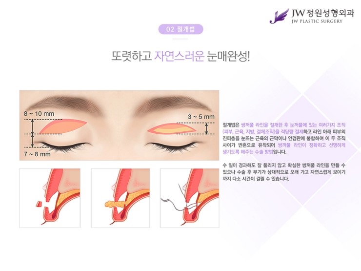 [JW정원성형외과] 나에게 맞는 눈성형 찾기! 관련 이미지 5