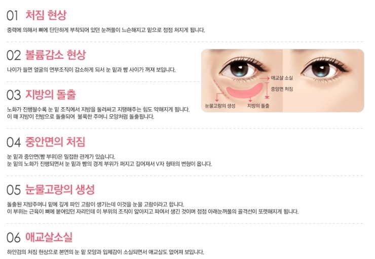 환한 눈매와 동안 얼굴을 동시에, JW정원성형외과 REWIND 하안검 관련 이미지 3