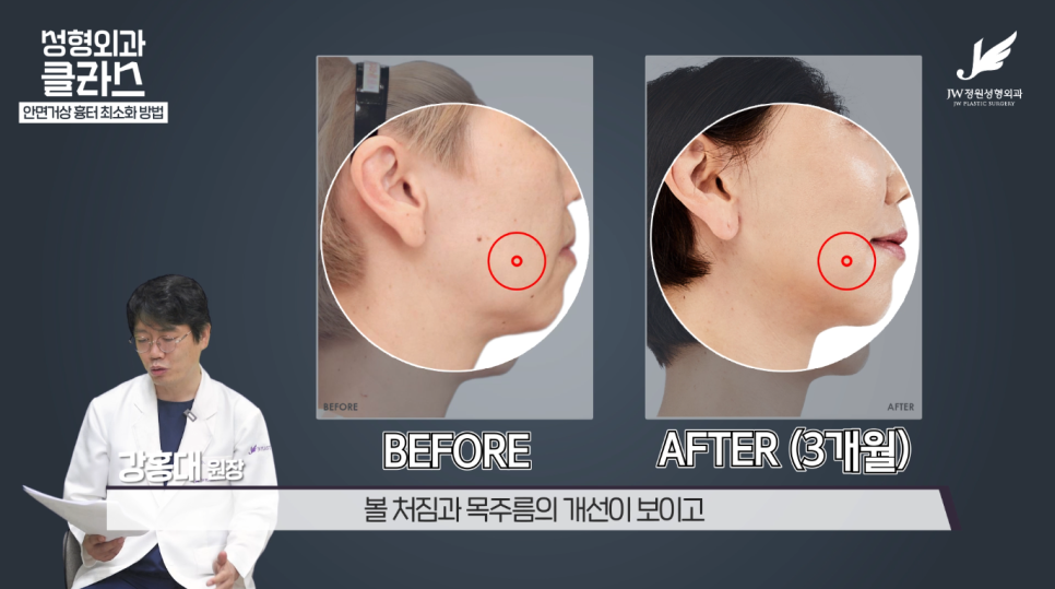 안면거상술후기 흉터 걱정 없이 깔끔하게!  【강남 JW정원성형외과】 관련 이미지 25
