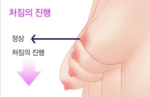출산과 모유수유로 인해 처진가슴은 JW정원성형외과에서! 관련 이미지 1