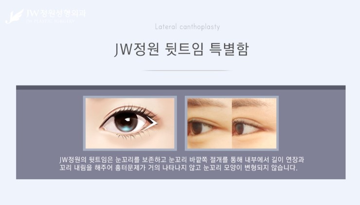 [JW정원성형외과] 시원한 눈매를 완성해주는 트임성형, 트임성형 잘하는 곳에서! 관련 이미지 9