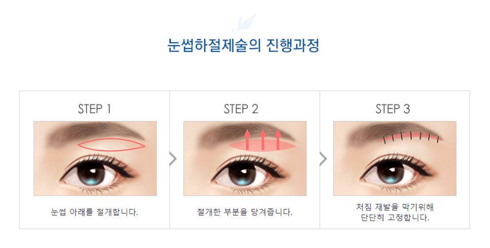 Achieve a More Youthful, Taut Eye Shape with Upper Blepharoplasty! (Eyelid Sagging Surgery) image 6