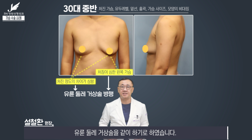 처진가슴교정 치밀한 계획으로 완성도는 UP! 【강남 JW정원성형외과】 관련 이미지 6