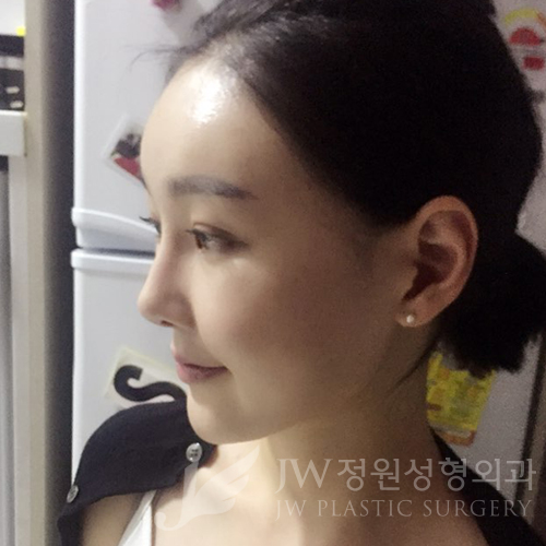 이마눈썹리프팅,눈매교정술,앞트임복원,코성형,지방이식 ⇒ JW정원성형외과에서! 관련 이미지 15
