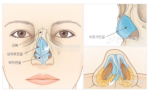 아름다운 코 라인과 기능개선을 동시에 JW정원성형외과 휜코 교정 관련 이미지 2