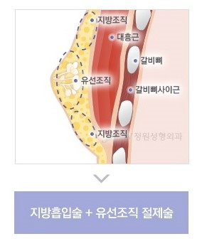 불룩한 가슴으로 고민이라면? 여성형유방(여유증) 성형도 역시 JW정원성형외과! 관련 이미지 6