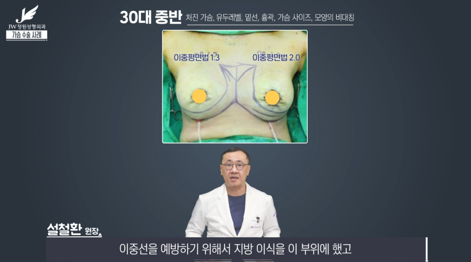 처진가슴교정 치밀한 계획으로 완성도는 UP! 【강남 JW정원성형외과】 관련 이미지 11