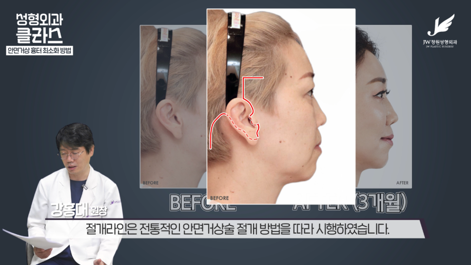 안면거상술후기 흉터 걱정 없이 깔끔하게!  【강남 JW정원성형외과】 관련 이미지 24