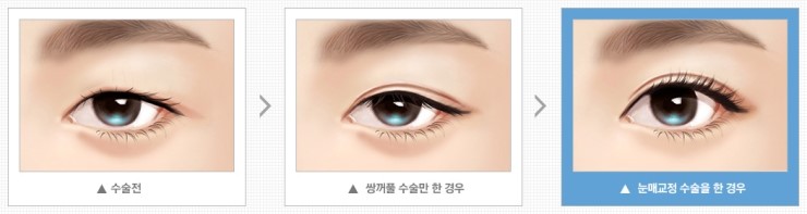 졸린 눈 No! 더 크고 더 또렷하게! JW정원성형외과 눈매교정 관련 이미지 3