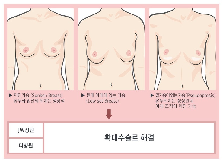 [JW정원성형외과] 처진가슴! 거상없이 확대수술만으로 해결! JW정원 처짐교정확대술 관련 이미지 2