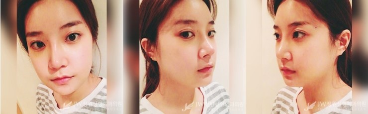 [JW정원성형외과] 안면윤곽 코성형 리얼 후기!!! 관련 이미지 2