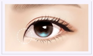 작고 답답한 눈매를 크고 시원스럽게! JW정원성형외과 360&deg; 멀티트임 관련 이미지 1