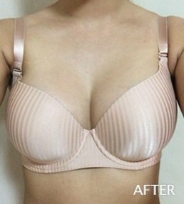 # HD내시경 물방울가슴확대는 JW정원성형외과에서 안전하게~ 관련 이미지 1