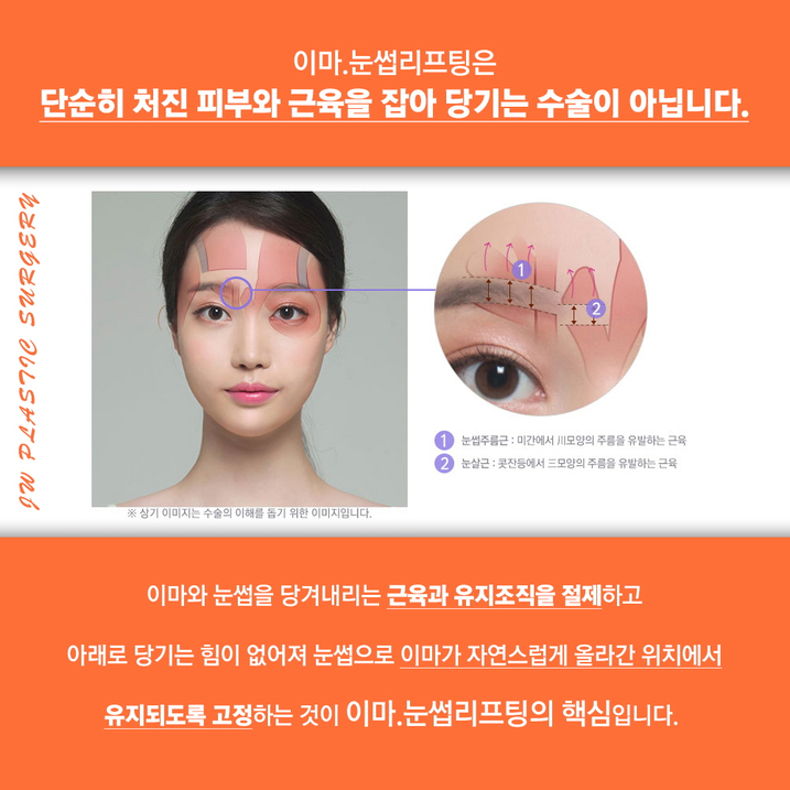 Endoscopic Forehead Lift, Improving a Drooping and Depressed Look to Complete a Youthful Appearance image 2