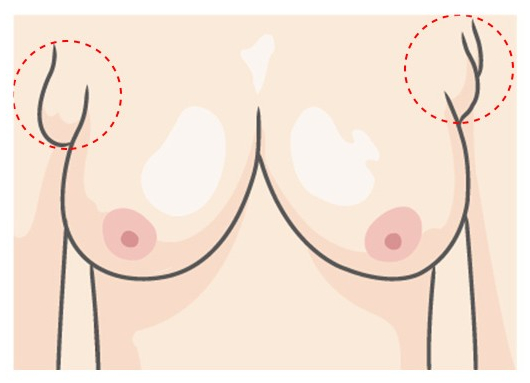 겨드랑이 부유방제거, 가슴성형잘하는 병원으로 알아보기 관련 이미지 2
