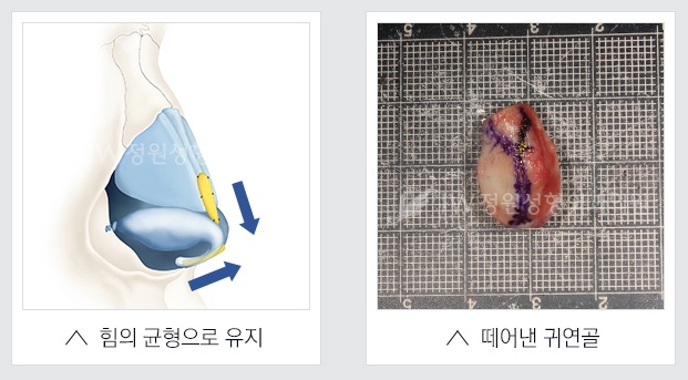 재수술한 코도 말랑하게! JW정원성형외과 핵심기술력 이중고정연장술! 관련 이미지 2