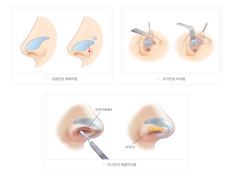 들창코수술 짧은코수술 [화려한 라인/자연스러운 라인] 내가 원하는 라인으로! 관련 이미지 6