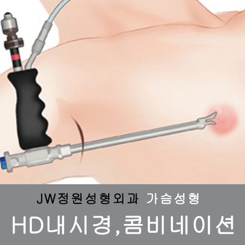 JW정원성형외과 가슴성형 √HD내시경 √하베스트젯2 √콤비네이션 가슴확대 관련 이미지 4