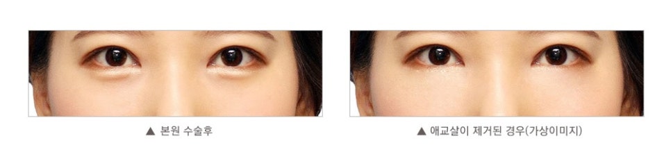 Best Place for Under-Eye Fat Repositioning, with a Surgical Method Suited to My Under-Eyes image 7