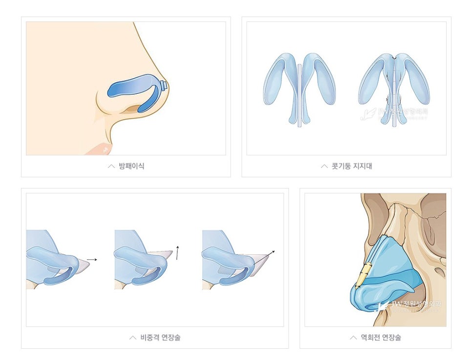 자연스럽게 움직이는 코끝, 처짐없는 코끝성형수술 알아봐요 관련 이미지 4