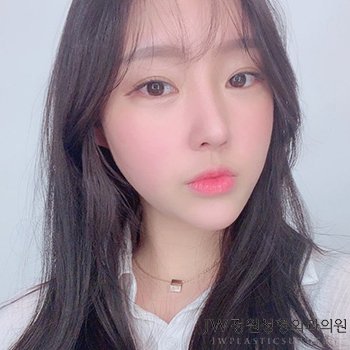 자연스럽게 움직이는 코끝, 처짐없는 코끝성형수술 알아봐요 관련 이미지 1