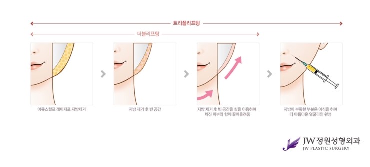 [JW정원성형외과] 리프팅성형비용 보다 리프팅효과가 확실한 트리플 리프팅으로 고민해결! 관련 이미지 3