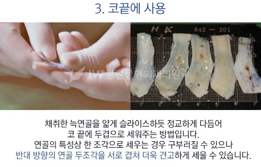 자연스러운 콧대! 견고한 코끝! JW정원성형외과 늑연골 코성형 관련 이미지 7