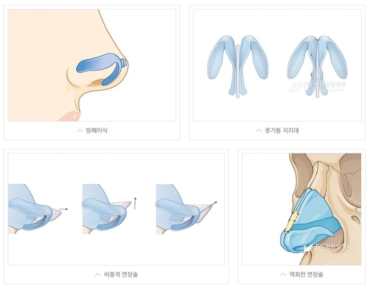 코끝에서 완성되는 아름다움! JW정원성형외과 코끝성형 관련 이미지 5