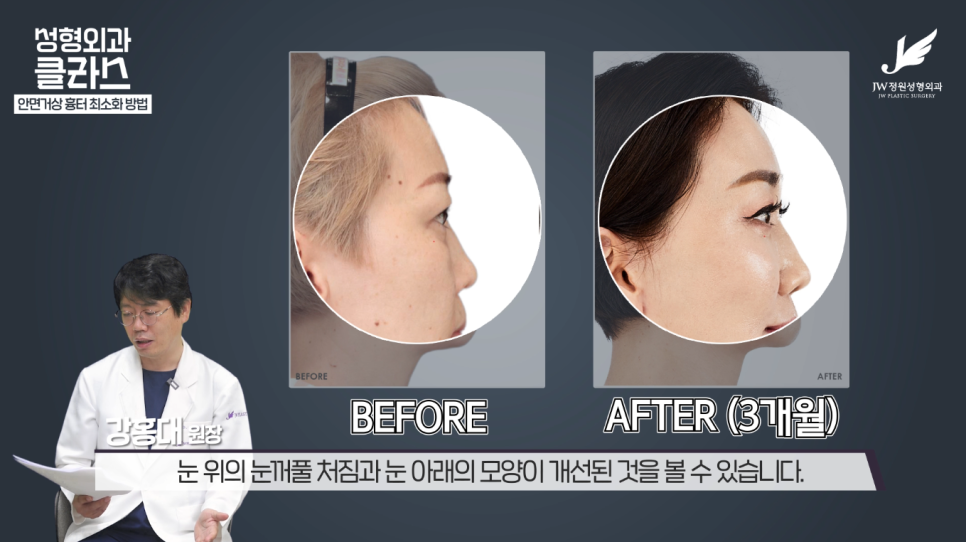 안면거상술후기 흉터 걱정 없이 깔끔하게!  【강남 JW정원성형외과】 관련 이미지 26