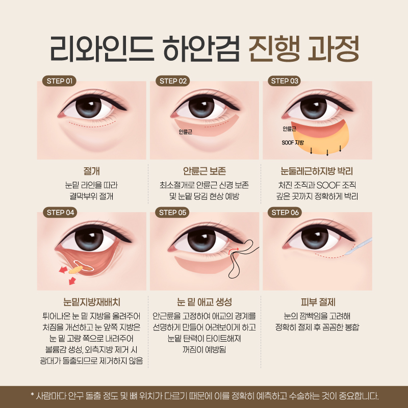 Lower Eyelid Surgery Review: Satisfying Results 【Gangnam JW Garden Plastic Surgery】 image 5