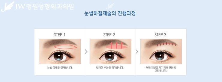 [JW정원성형외과] 처진 눈꺼풀을 탄력 있는 눈매로! 상안검성형 관련 이미지 8