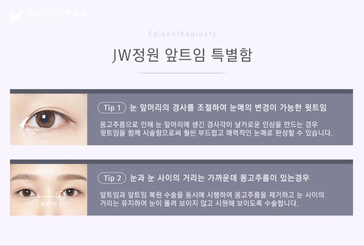 [JW정원성형외과] 시원한 눈매를 완성해주는 트임성형, 트임성형 잘하는 곳에서! 관련 이미지 5