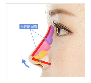 재수술 없는 JW정원성형외과 늑연골 코성형 관련 이미지 7