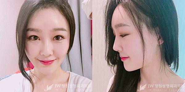 단아하고 매력적인 미모&hearts; JW정원성형외과 리프팅+눈+코+지방이식으로 관련 이미지 6