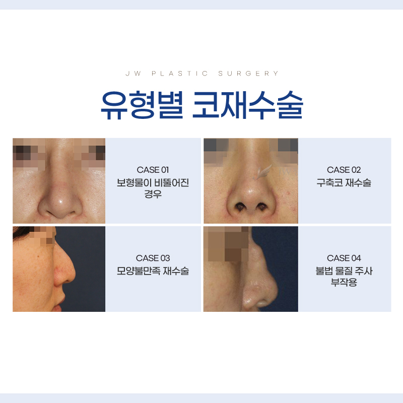 Nose Revision Surgery Review: Careful Work to Avoid Further Side Effects image 2
