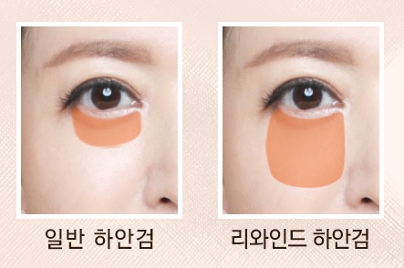 Three-Dimensional Under-Eye Contours Can Be Restored to How They Looked 10 Years Ago with Lower Blepharoplasty image 3
