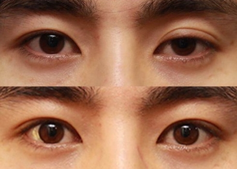 정확한 원인 판단과 시술로 완성하는 JW정원성형외과 눈재수술 관련 이미지 8