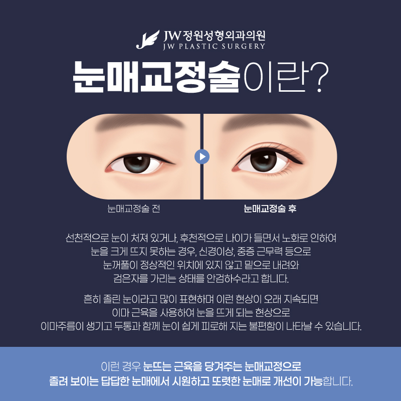 강남눈매교정 뚜렷한 이미지를 가지고 싶다면 관련 이미지 3