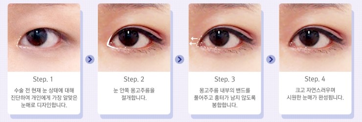 작고 답답한 눈에서 시원시원한 눈으로! JW정원성형외과 트임수술 관련 이미지 5