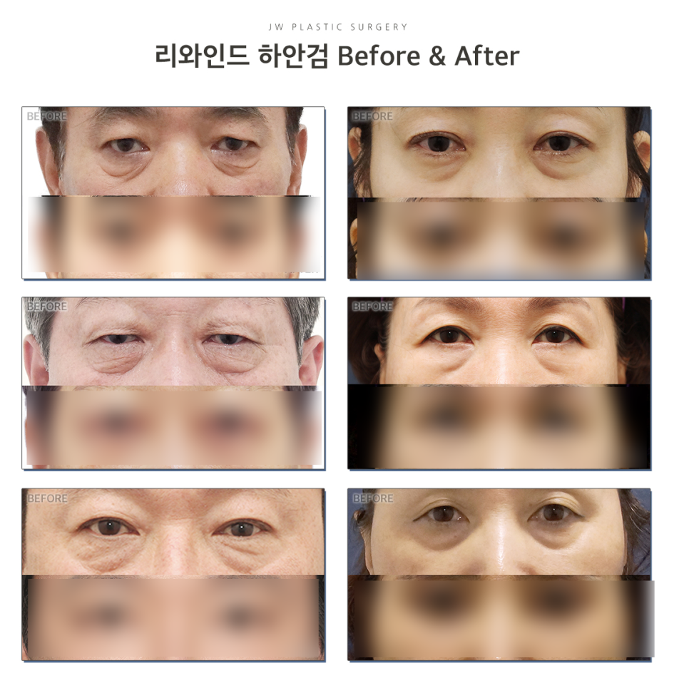 JW Garden Lower Blepharoplasty to Meet the Younger Me Again image 3