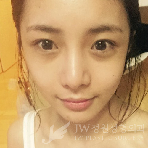 코재수술도 역시 JW정원성형외과 서만군원장 :] 관련 이미지 11