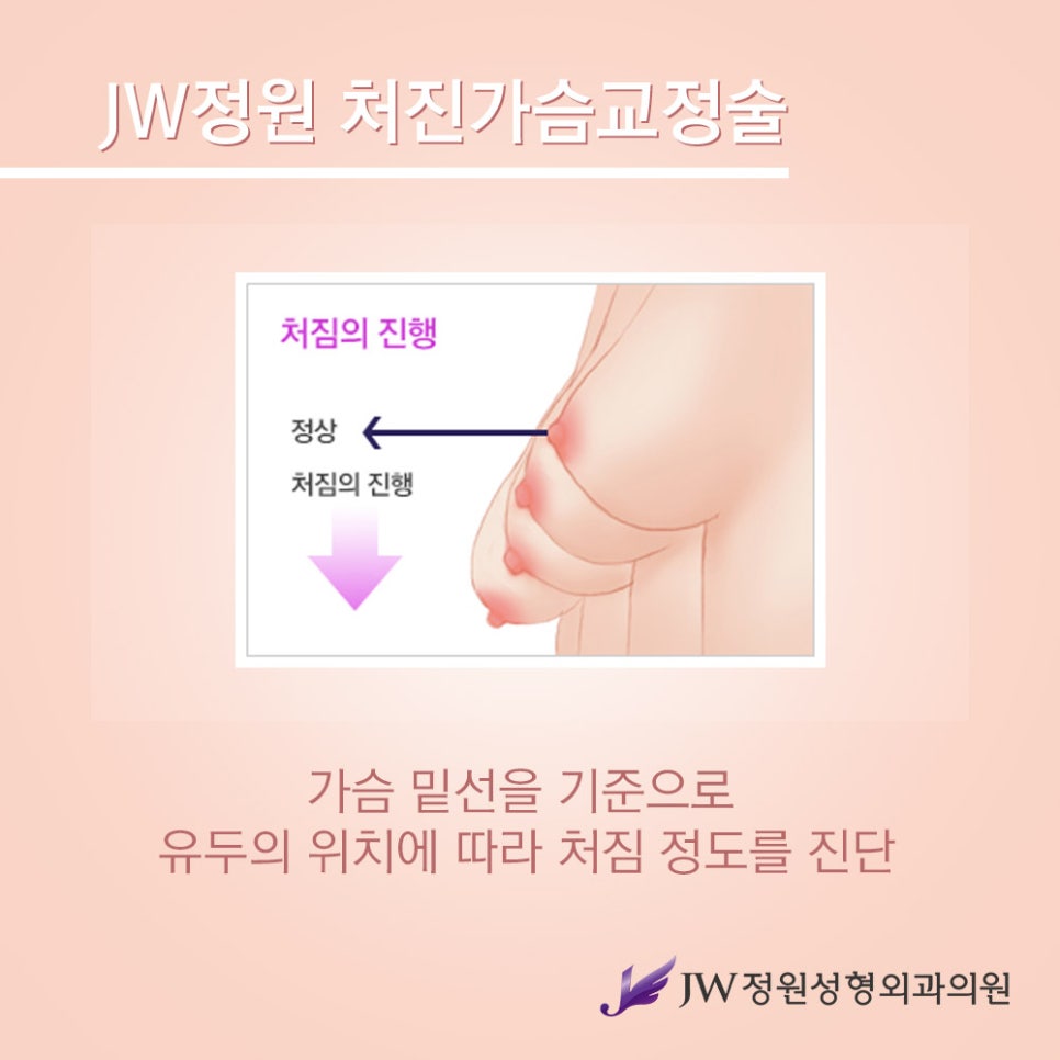 Breast Lift Surgery for Drooping Breasts, with a Natural and Firm Result image 2